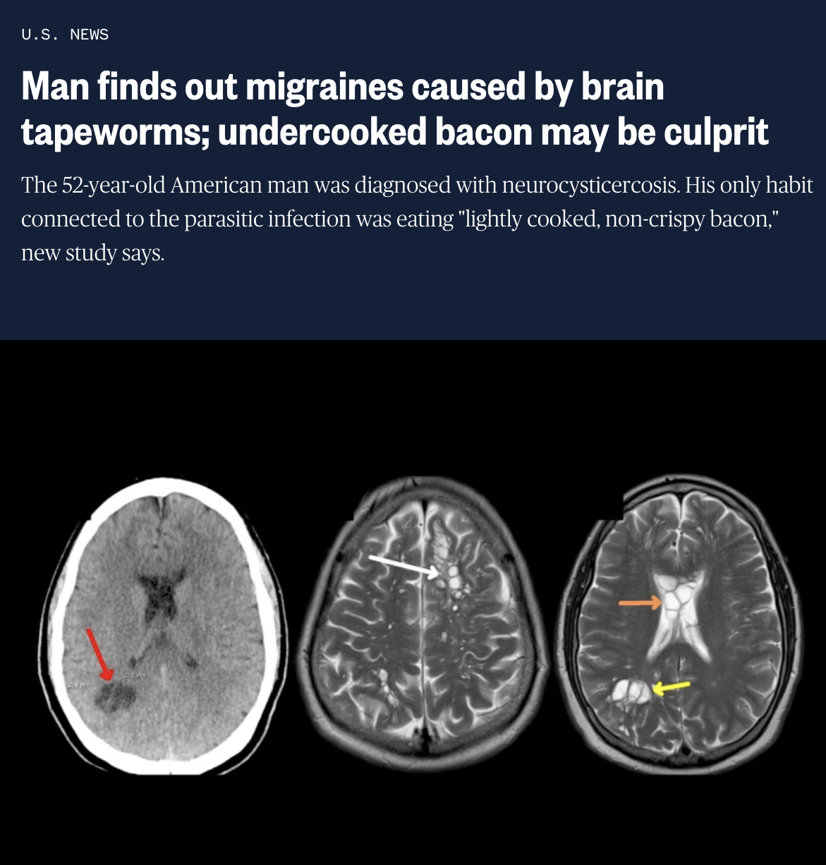 brain - U.S. News Man finds out migraines caused by brain tapeworms; undercooked bacon may be culprit The 52yearold American man was diagnosed with neurocysticercosis. His only habit connected to the parasitic infection was eating "lightly cooked, noncris
